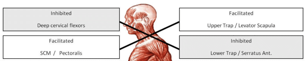 Upper Cross Syndrome